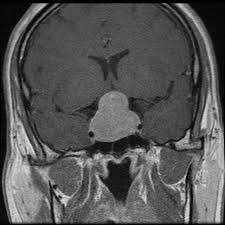 Resonancia magnética cerebral sagital con masa tumoral visible