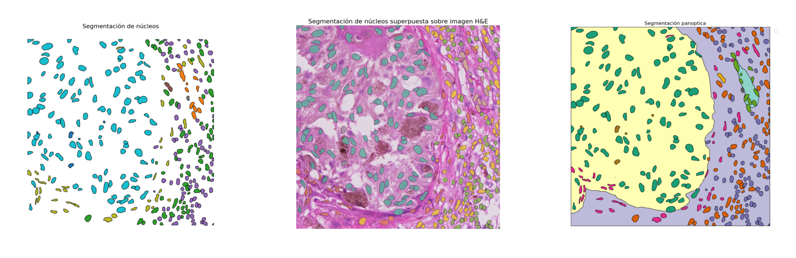 Segmentación de núcleos superpuesta sobre imagen H&E real — modelo aplicado a tejido de melanoma metastásico